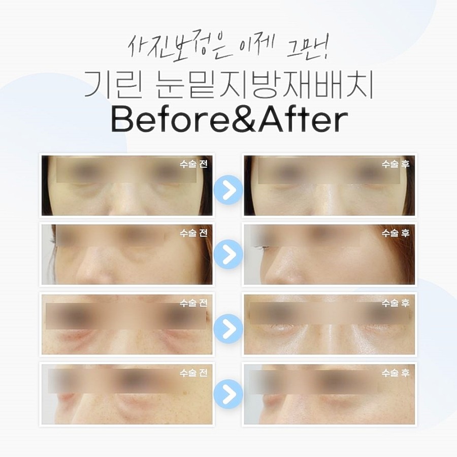 눈밑지방재배치 레이저 vs 수술후, 그동안 걱정했다면 관련 이미지 10