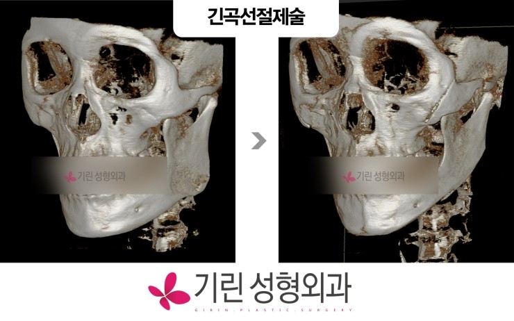 얼굴뼈(bone)+ 엑스레이 + 3DCT  사각턱수술 전후비교 관련 이미지 3