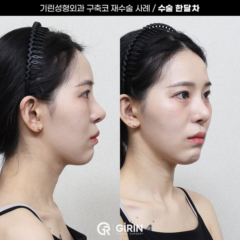 기린성형외과 코성형 구축코 재건 사례 관련 이미지 5