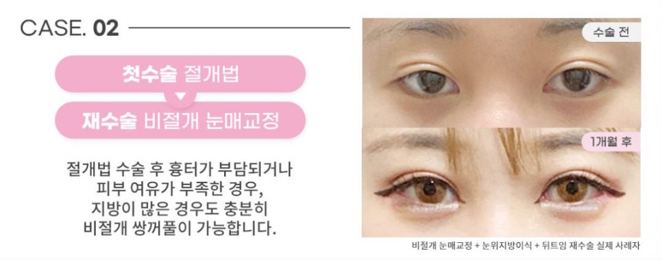 소세지눈재수술? 더는 실패 없는 비법 1가지 관련 이미지 4