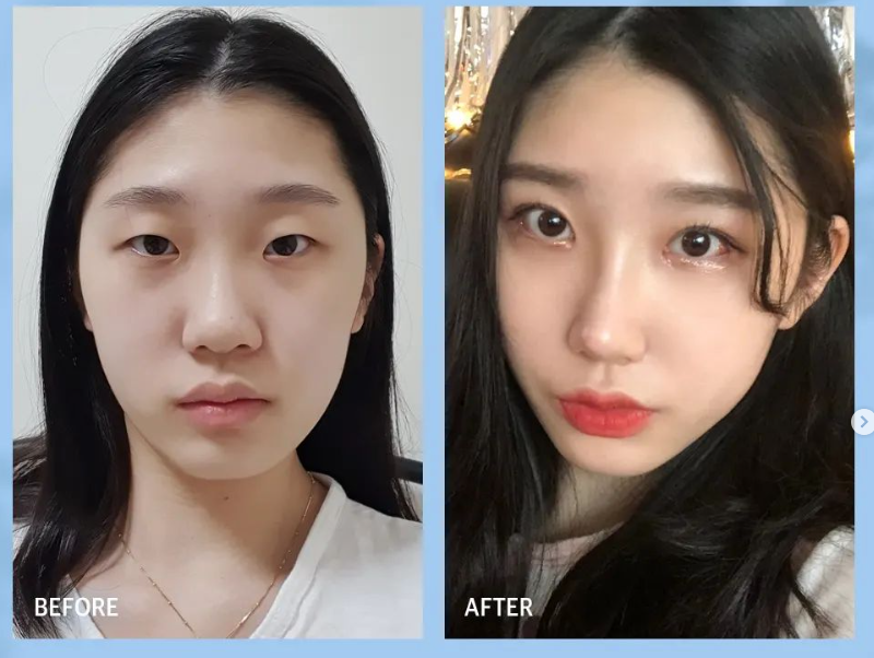 낮은코수술 눈에 보이는 차이를 원한다면 관련 이미지 13