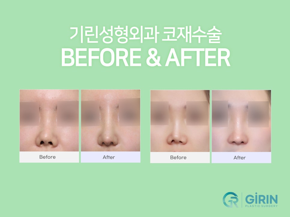 강남코재수술 원인 생각하여 관련 이미지 4