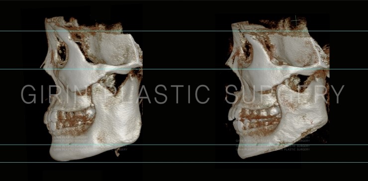 뉴브이라인, 아큐스컬프 6개월 경과 관련 이미지 3