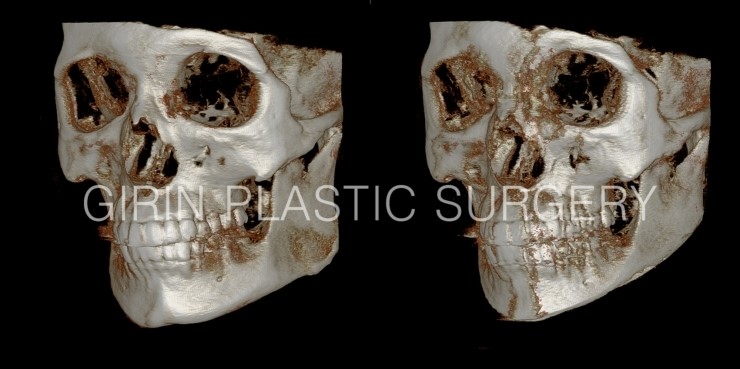 긴곡선브이라인 16일째 경과 관련 이미지 5