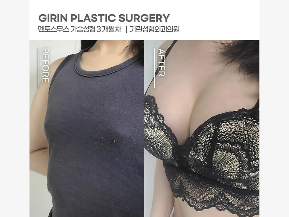 가슴수술잘하는곳 과정도 확인하며 관련 이미지 9