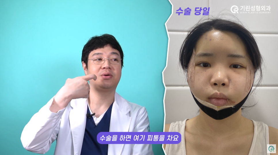[기린성형외과의원] ❌보정어플은 당장 삭제❌_윤곽3종 수술일지 관련 이미지 10