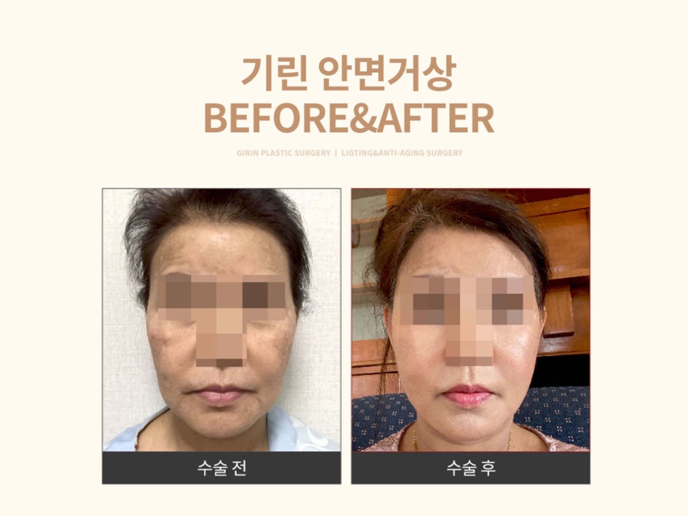 안면거상수술 효과 확실하려면 관련 이미지 16