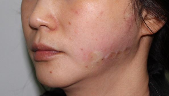 비수술 리프팅, 어떤 종류가 있을까? 관련 이미지 4