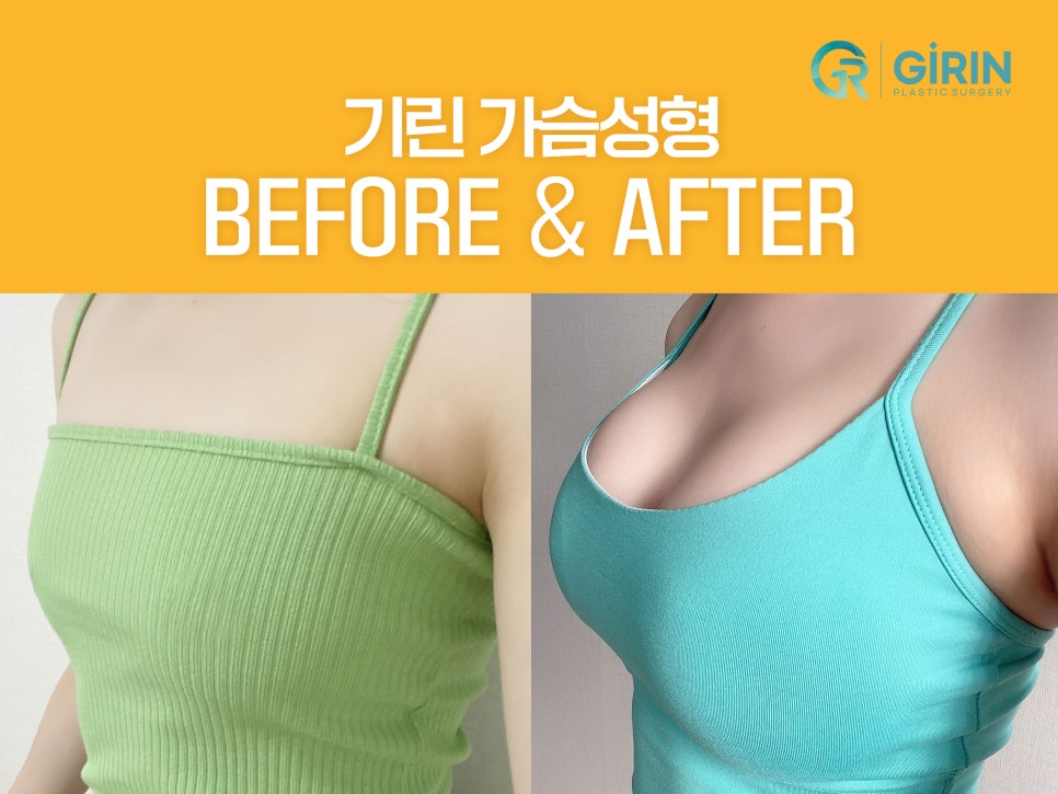 모티바가슴성형후기 세심하게 살펴보며 관련 이미지 6