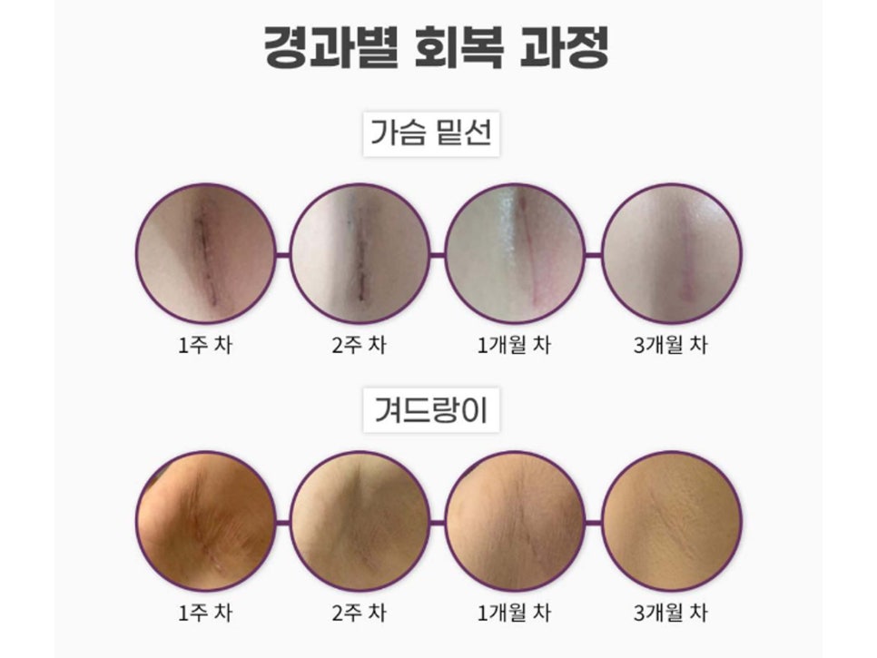 멘토가슴성형 차이를 알고 선택해야 관련 이미지 11
