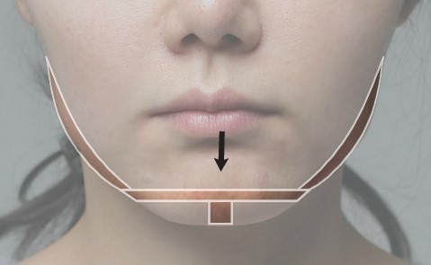 티절골은 어떤 수술일까 (수술후bone) 관련 이미지 2