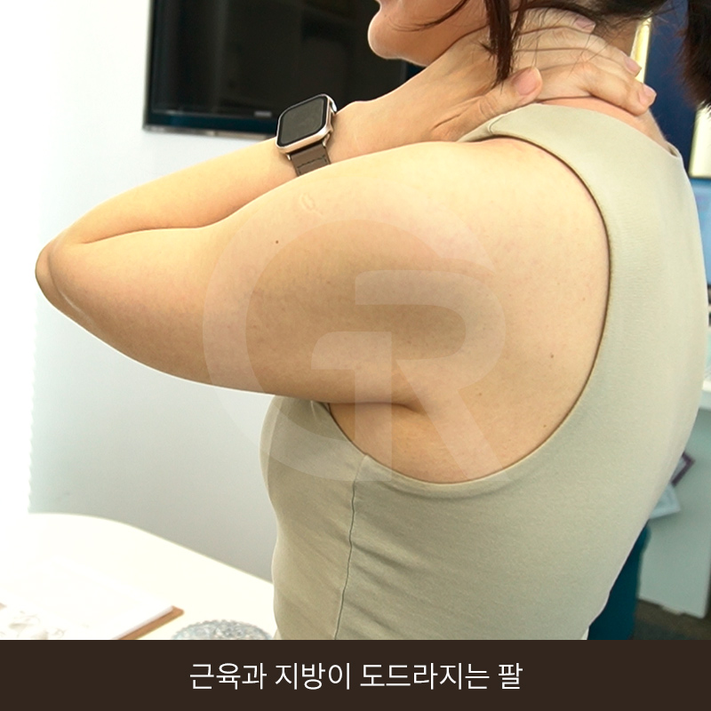 요가로 소용없던 굵은 팔뚝 지방흡입 수술 후기 관련 이미지 5