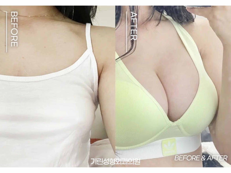 멘토가슴성형 다른 점이 무엇일까? 관련 이미지 1