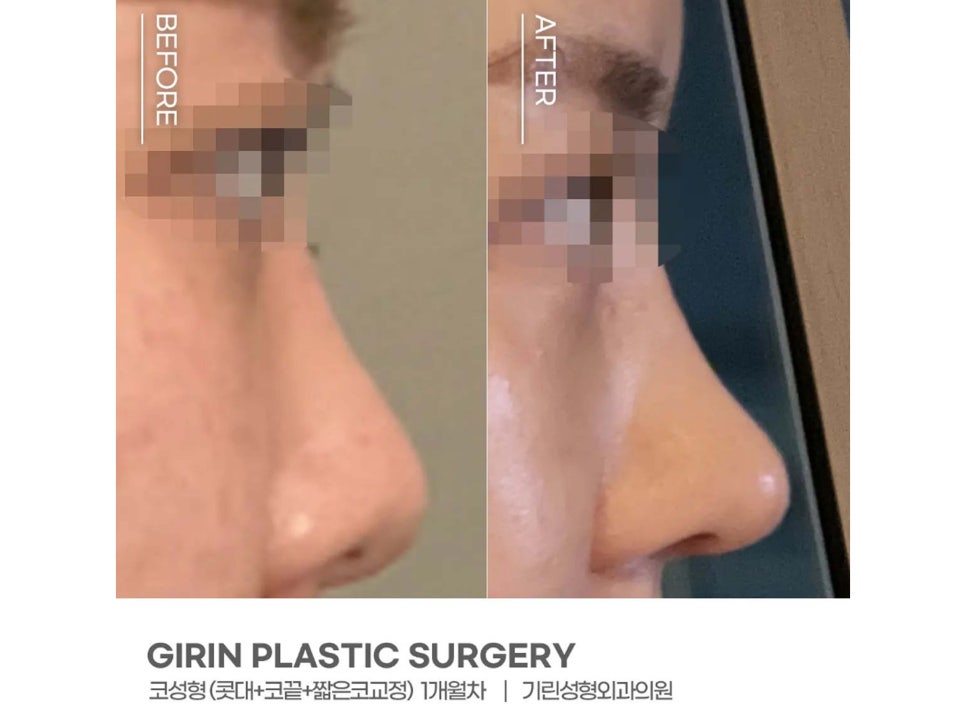 서울코수술 생김새에 따라 다르게 관련 이미지 4