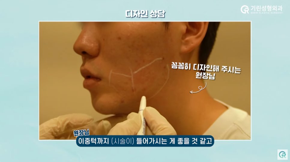 [기린성형외과의원] 수술 없이 턱라인 개선하기_인모드와 지방분해주사 관련 이미지 2