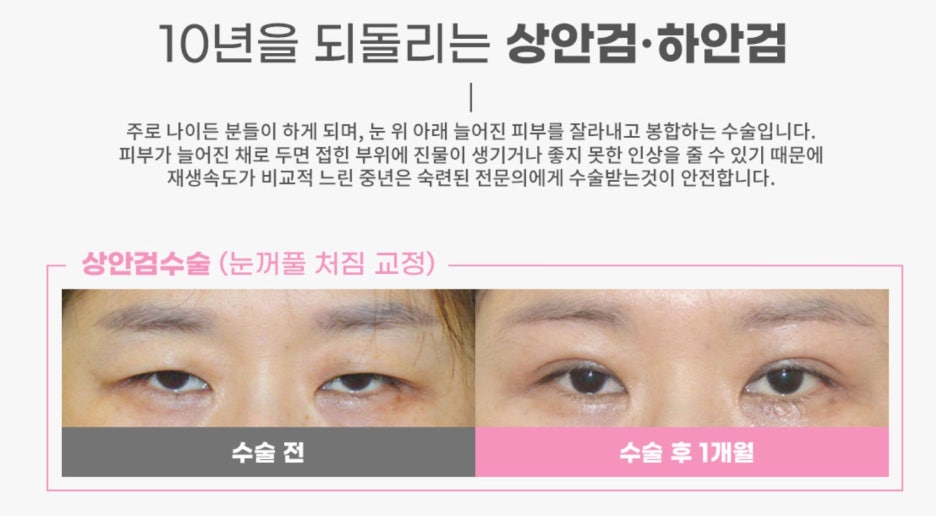 상안검수술잘하는곳 이유가 있다! 관련 이미지 4