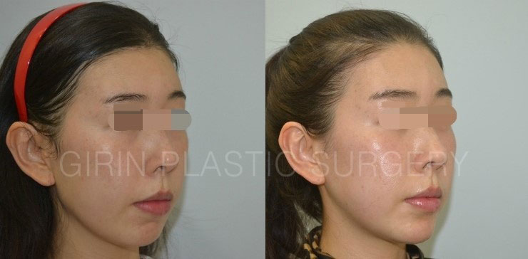 긴곡선절제술 6주차 앞턱변화 모습 관련 이미지 2