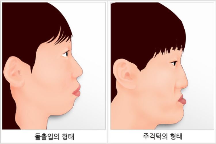 돌출입 수술, 꼭 양악으로 해결해야 할까? 관련 이미지 1