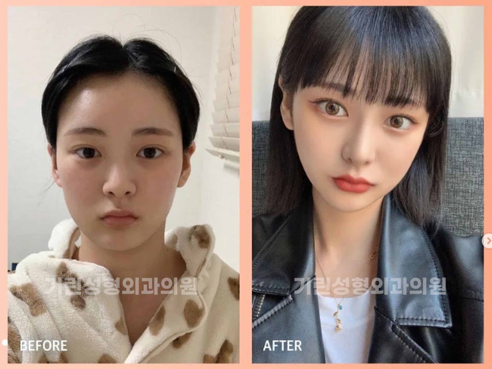 강남역성형외과유명한곳 얼굴에 맞춰 조화롭게 관련 이미지 1