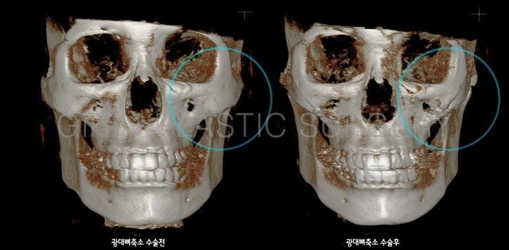 앞광대가 크게 발달한 유형 관련 이미지 3