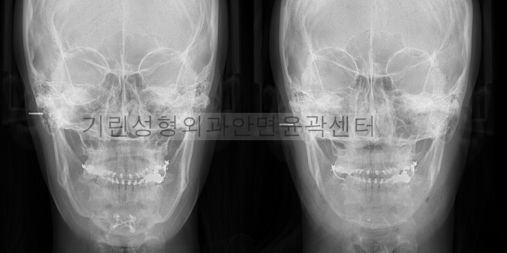 윤곽부작용사례- 이차각재수술CT 관련 이미지 6
