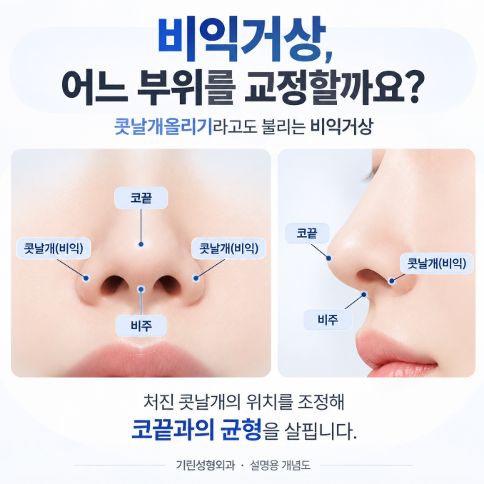 비익거상, 코수술할 때 처진 콧볼을 함께 보는 이유 관련 이미지 2