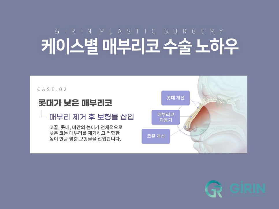 매부리코수술후기 방법까지 확인해 관련 이미지 8