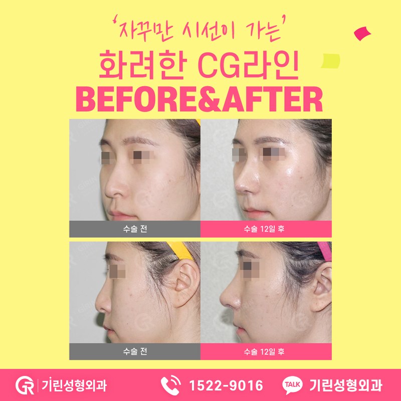 코성형가격 전에 알아야할 것들 관련 이미지 4