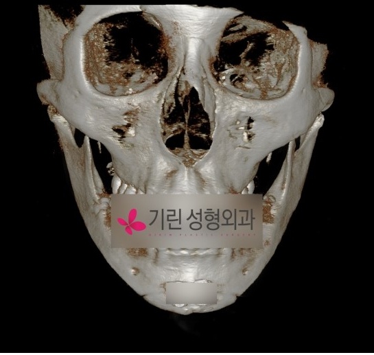 안면윤곽부작용 이차각으로 인한 재수술 관련 이미지 2
