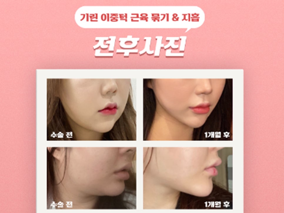 이중턱성형 차이가 궁금하다면 관련 이미지 11