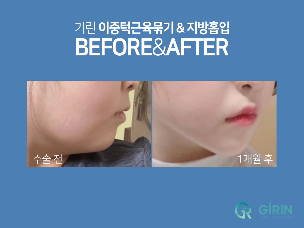 이중턱근육묶기 탄력 저하 잡아주는 관련 이미지 10