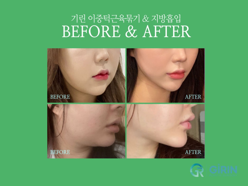 이중턱수술 확실히 효과 보려면 관련 이미지 8