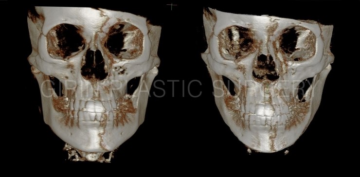 긴곡선브이라인 수술후3주 ->4주 경과 관련 이미지 3