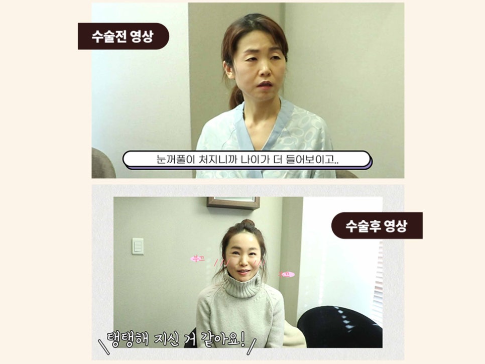 처진눈수술 눈매를 바꾸는 방법 관련 이미지 8