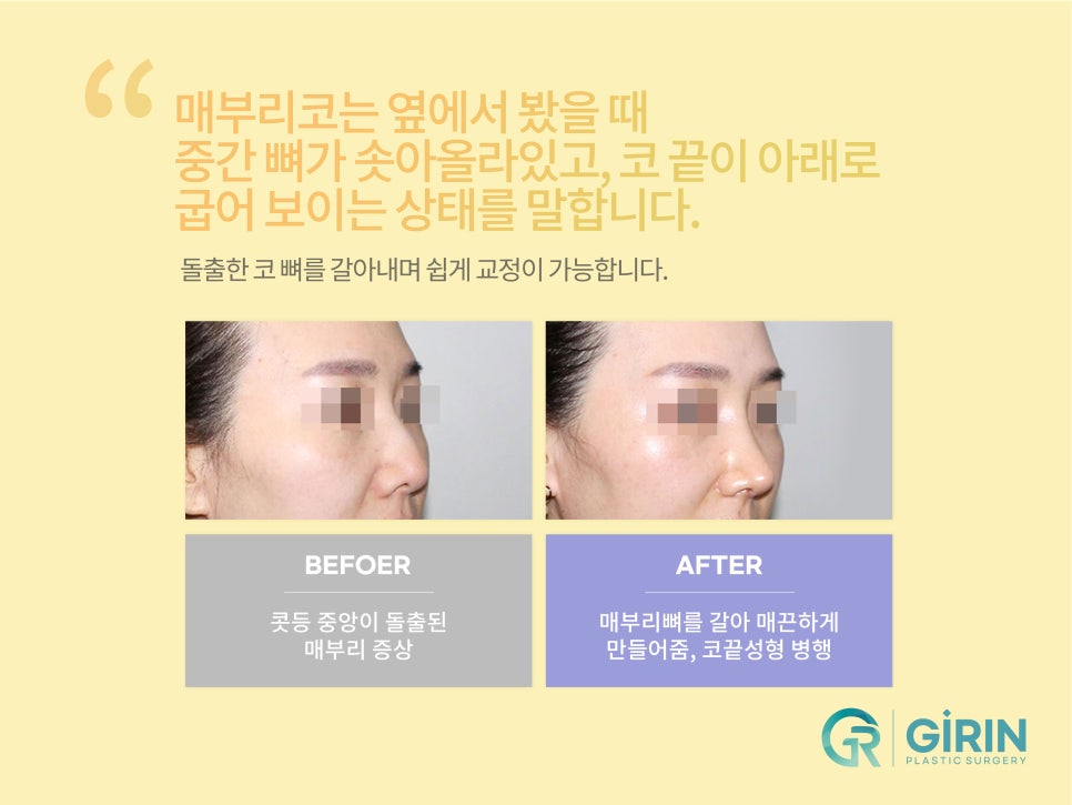 여자코성형 원하는 라인 고려하여 관련 이미지 3