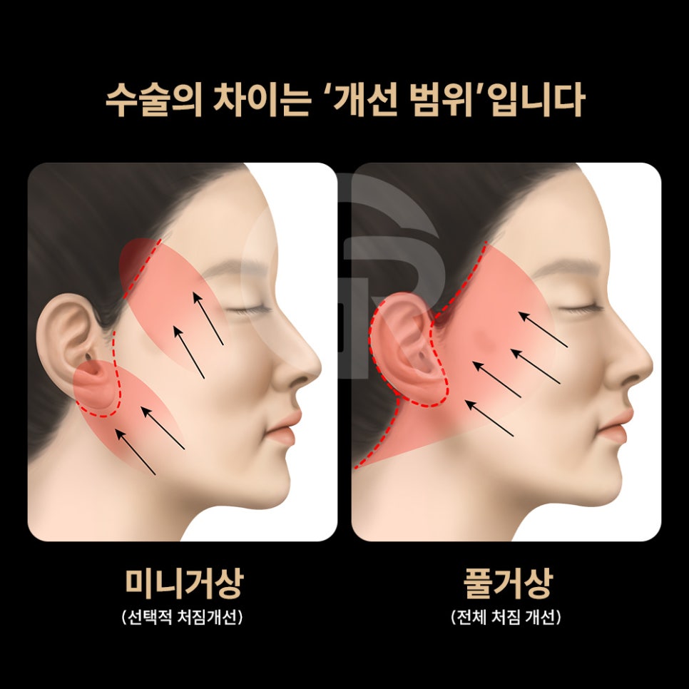 위고비&middot;마운자로 후 얼굴처짐으로 인한 미니거상 후기 관련 이미지 6
