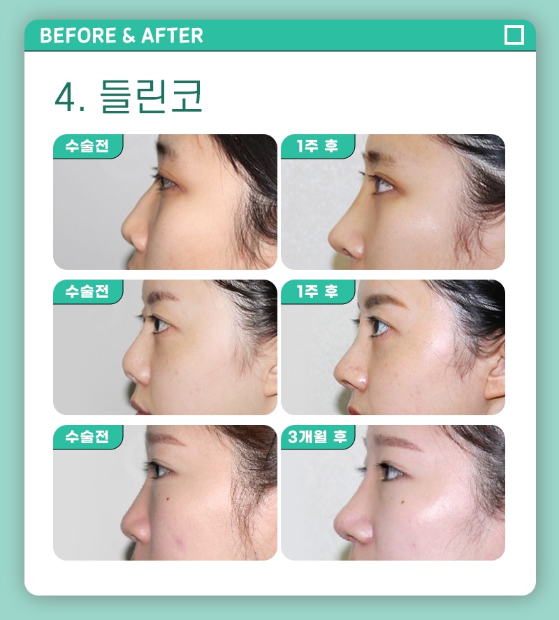 코성형수술비용 확실한 기준으로 정확하게 관련 이미지 4