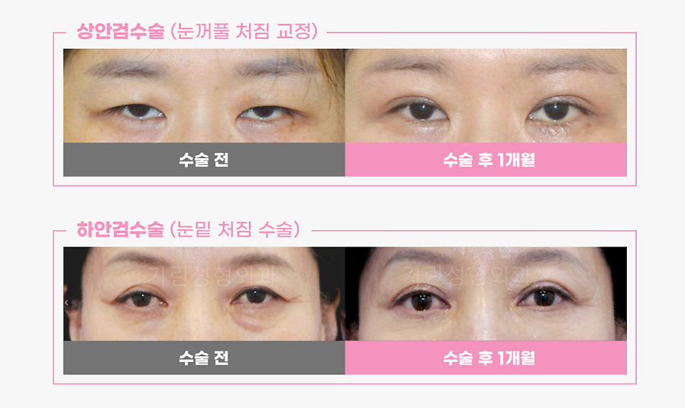 강남눈성형 눈가 주름 개선을 위해 관련 이미지 9