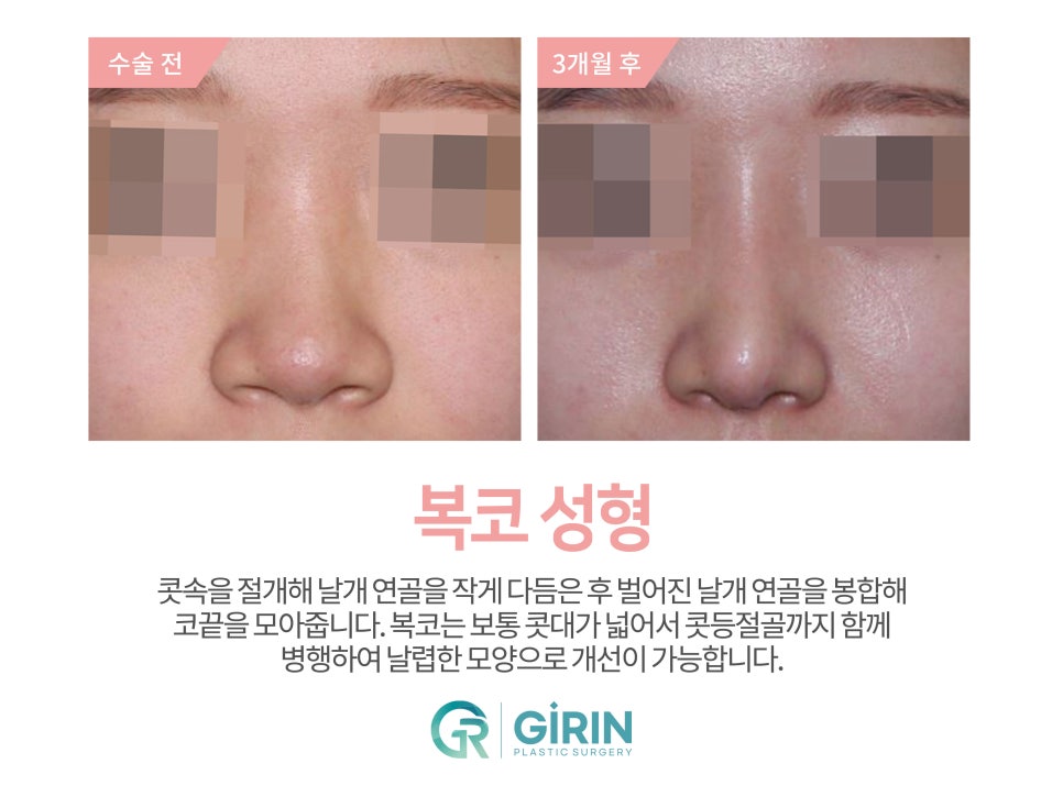 여자코수술 모양도 고려하여 관련 이미지 9
