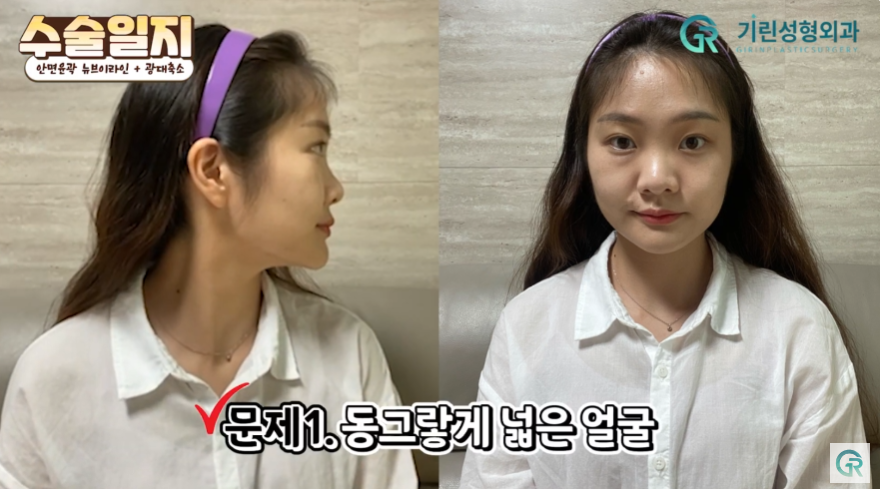 [기린성형외과의원] "카리나가 되고싶어요"_안면윤곽 수술일지 관련 이미지 3