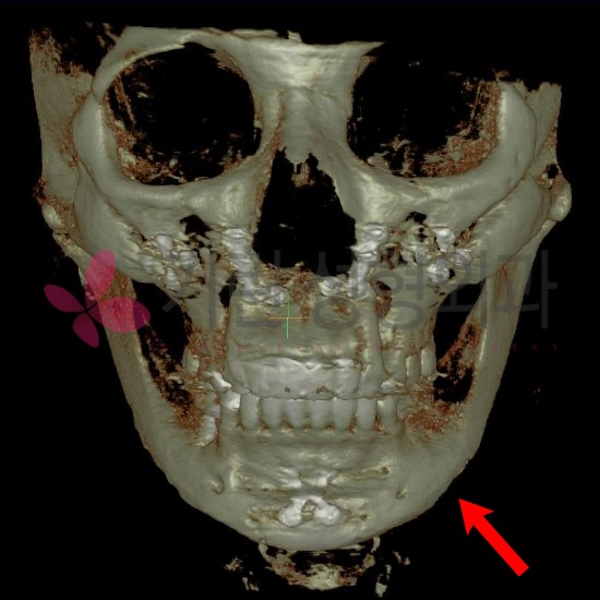 앞턱수술후 재수술사례(티절골부작용) 관련 이미지 2
