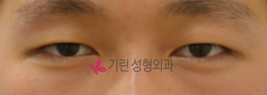 남자 쌍꺼풀수술 자연스럽게 ★ 관련 이미지 1