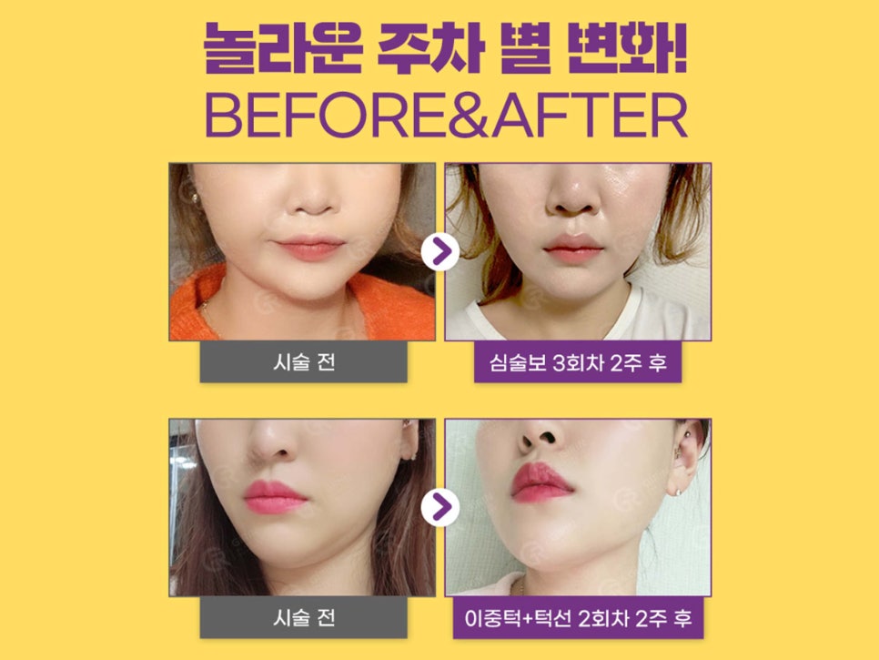 강남윤곽주사 스테로이드 선택도 가능해 관련 이미지 1