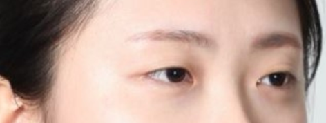 뒤트임 눈성형수술, 기린만의 특별화된 7mm 뒤트임. 관련 이미지 4