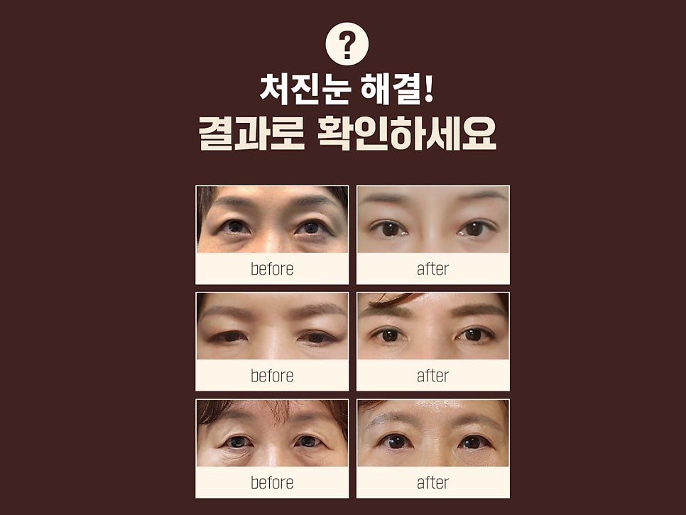 상안검수술회복기간 확인하자 관련 이미지 11