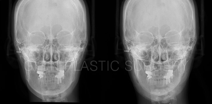 긴곡선절제술 6주차 앞턱변화 모습 관련 이미지 4