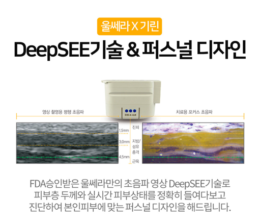 내 피부에 꼭 맞는 리프팅, 퍼스널울쎄라 관련 이미지 4