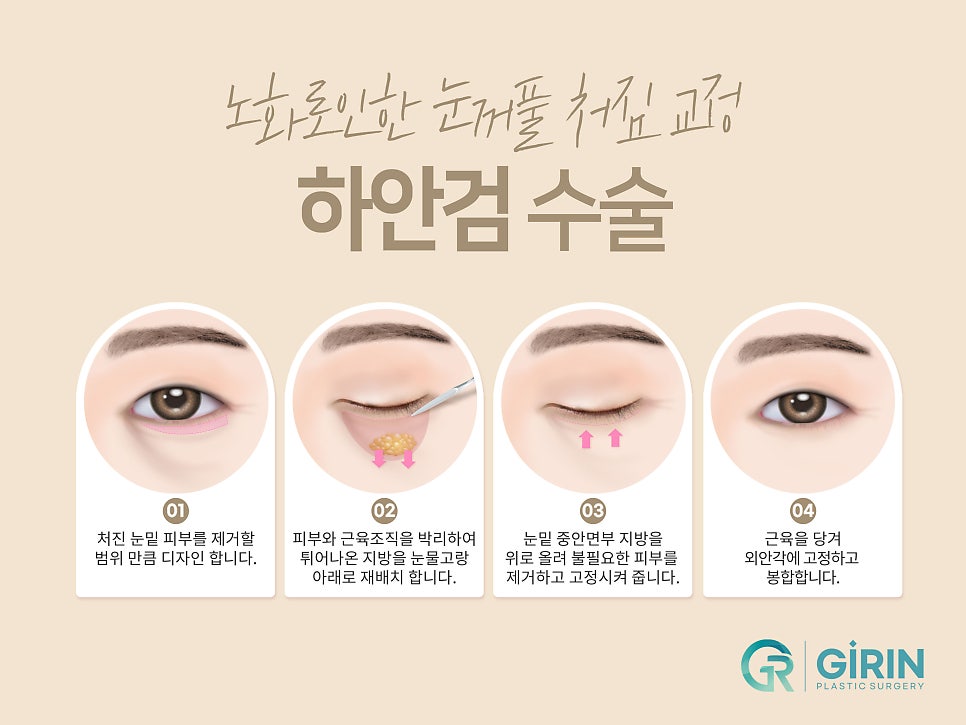 처진눈성형 다시 눈매를 잡아주며 관련 이미지 9