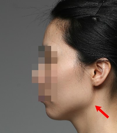 뉴브이라인수술로 귀밑각부터 턱끝까지 절골한 경우(하악각제거범위) 관련 이미지 1