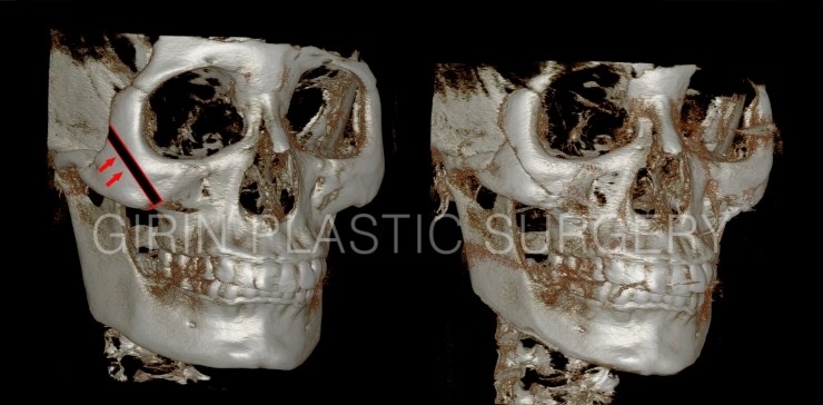 광대축소 불유합과 L절골에 대해 관련 이미지 3